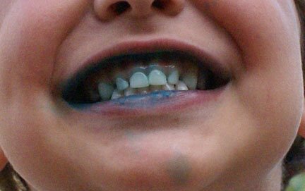 [blue+teeth]