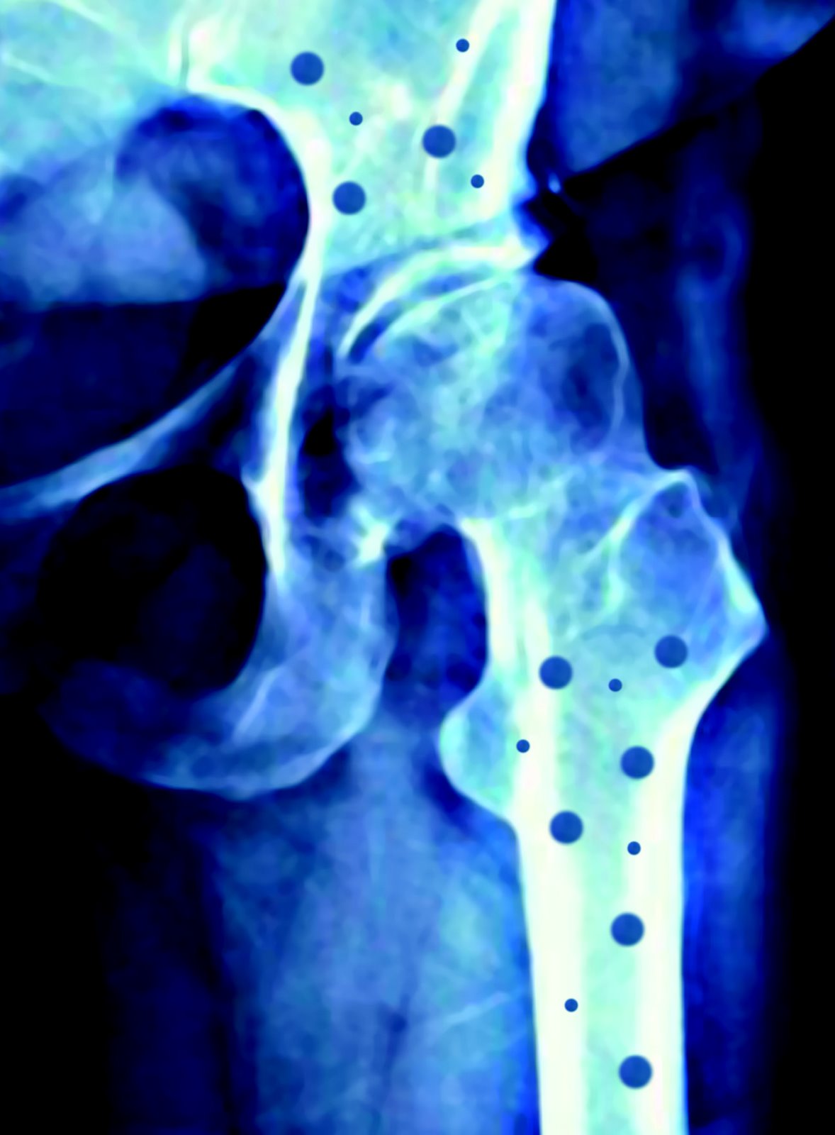 [osteoporisis.jpg]