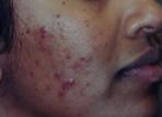 [acne.jpg]