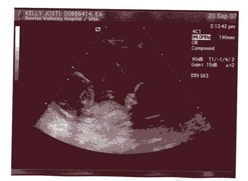[ultrasound+18+weeks+004.jpg]