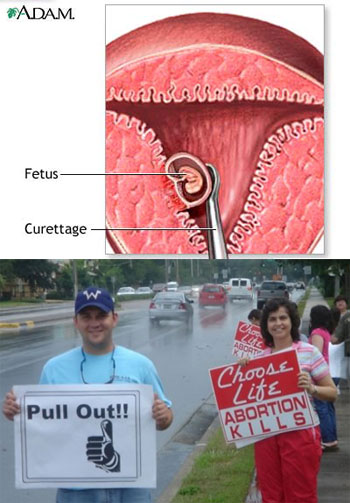 [abortionprocedure.jpg]