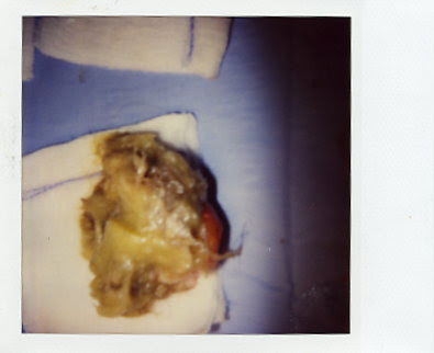 Rare little fatty tumors filled with calcified body parts.hair, nails,