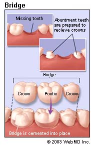 [dental_health_bridges_bridge.jpg]