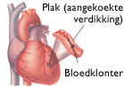 [diabetes_plaque_nl.gif]