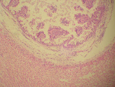 Hiperplasia del epitelio biliar