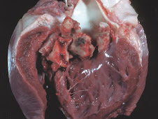 Endocarditis valvular (cerdo)