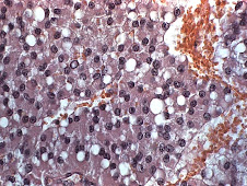 Tumor de células de Leydig