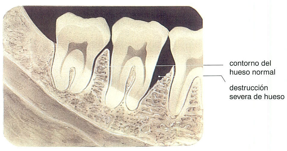 [periodontal_tratar_l.jpg]