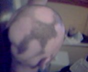 [Alopecia_areata_head.jpg]