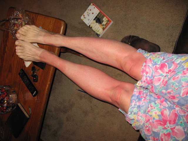 [sunburned+legs+001.jpg]