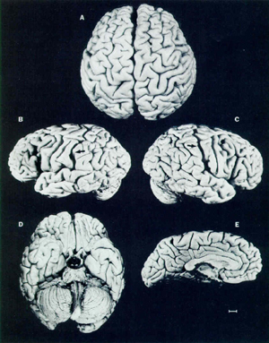 [Einstein's_brain_(Lancet).jpg]