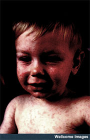 [measles_child.jpg]