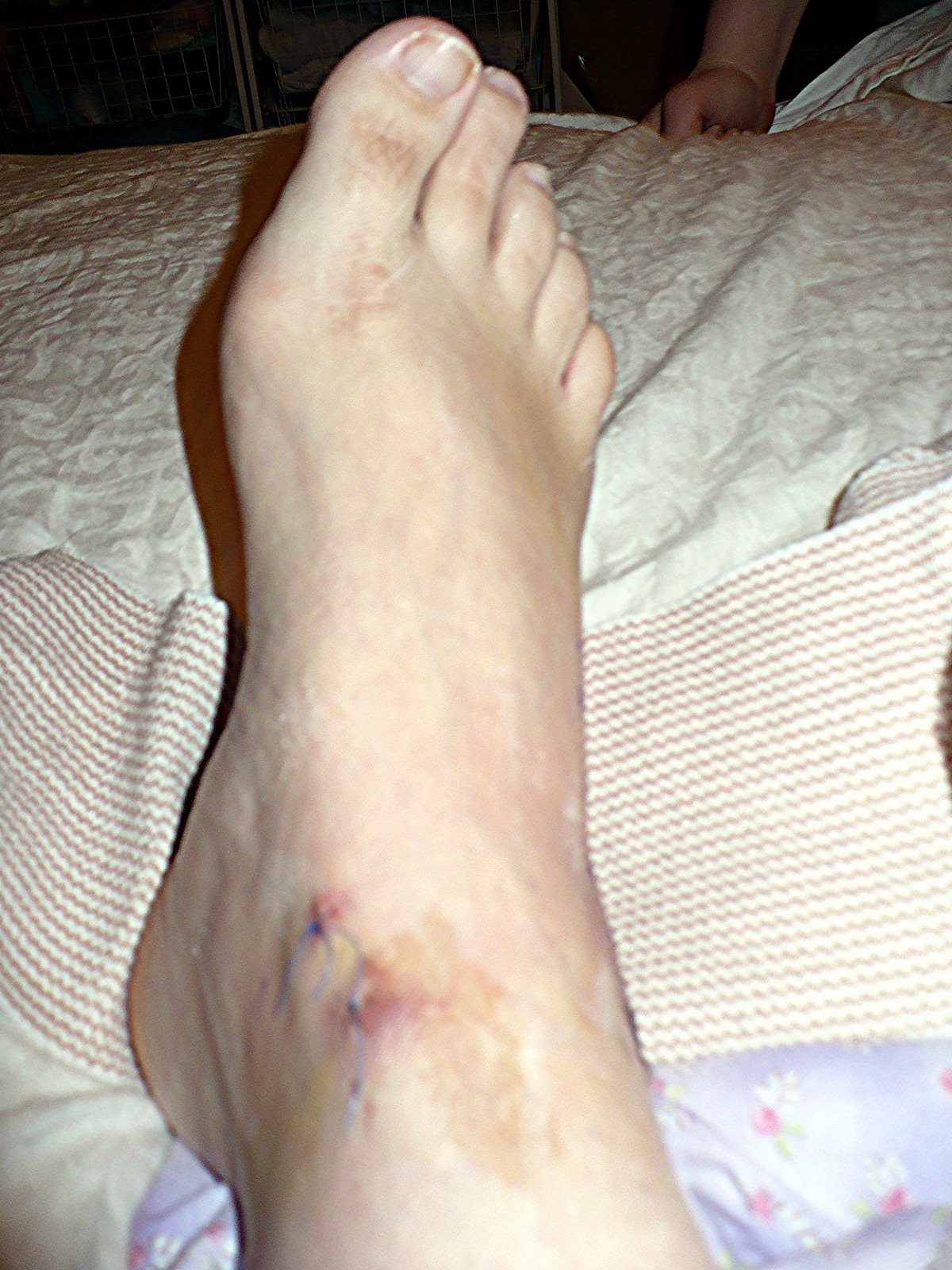 [ankle+surgery2.jpg]