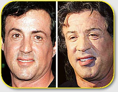 Famosas operadas: Fotos del antes y el despues Sylvester+Stallone