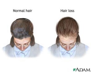 [Female+Hair+Loss.jpg]