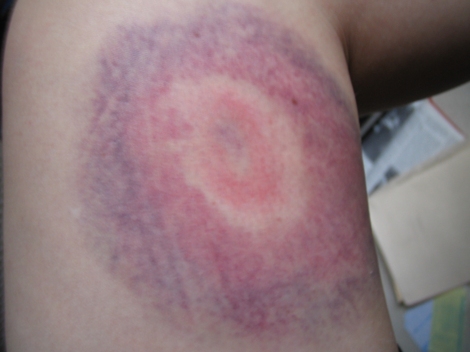 [bruise.JPG]