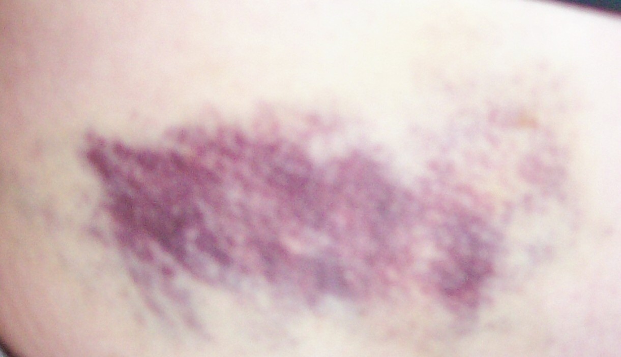 [bruise+detail.jpg]