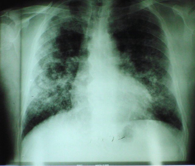 [chest_silicosis_01.jpg]