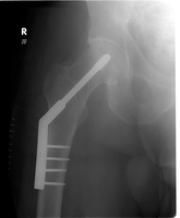 [hip+fracture.jpg]