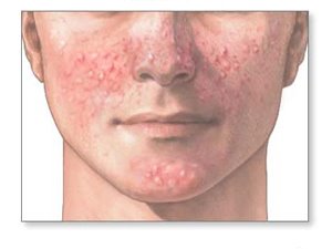 [acne-interna.jpg]