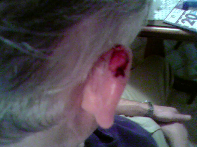 [2007Aug02+Ear+Surgery+view+of+ear.jpg]