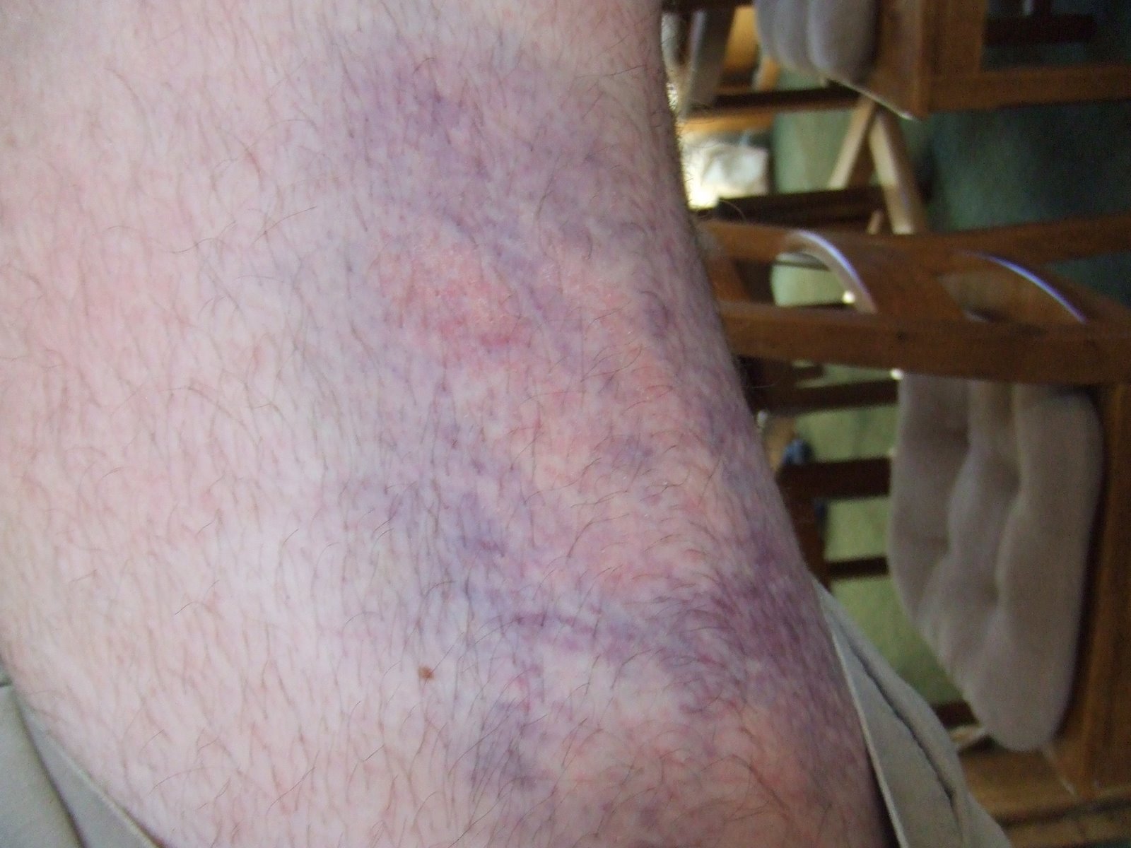[bruise+day2.JPG]