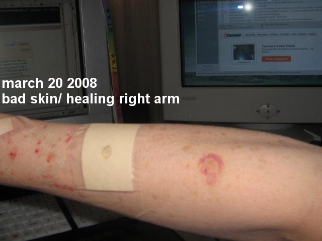 [2008_03_20_healing+right+arm.jpg]
