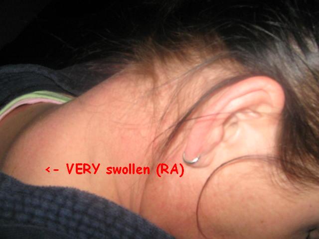 [2007_11_25_RA_neck+veryswollen.JPG]