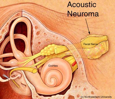 [Acoustic%20Neuroma1s2w.jpg]