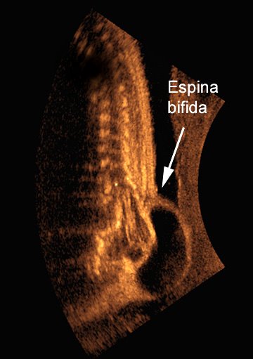 [espina-bifida.jpg]
