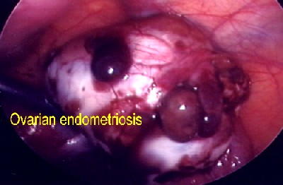 Endometriosis and Chocolate Cyst