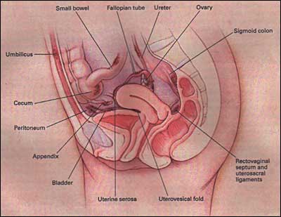 Common Sites of Endometriosis