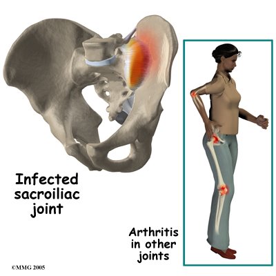 [SI_joint_causes01.jpg]