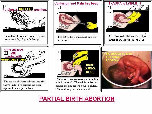 [partial_birth_abortion.jpg]