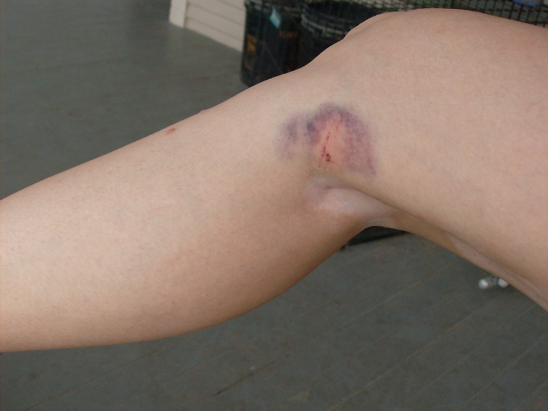 [bruise1.jpg]