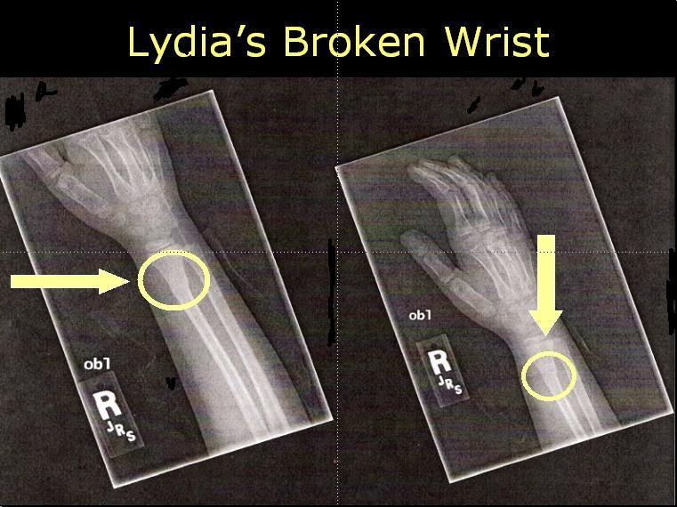 [Lydia+Broken+Wrist.jpg]