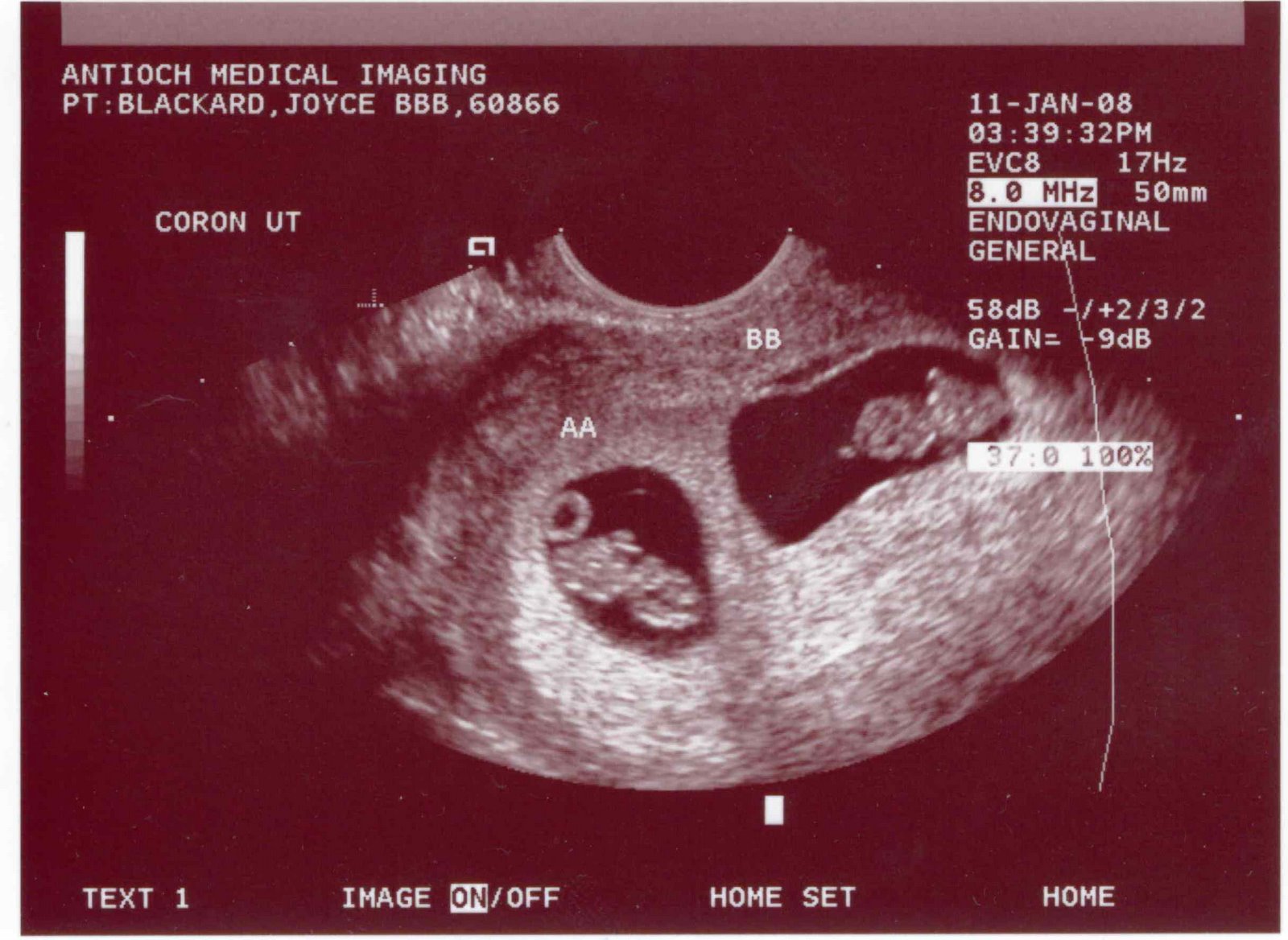 [Vaughn-Woelfel+embryos+@+8-week+ultrasound.cropped.jpg]