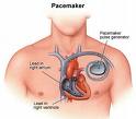 [pacemaker.jpg]