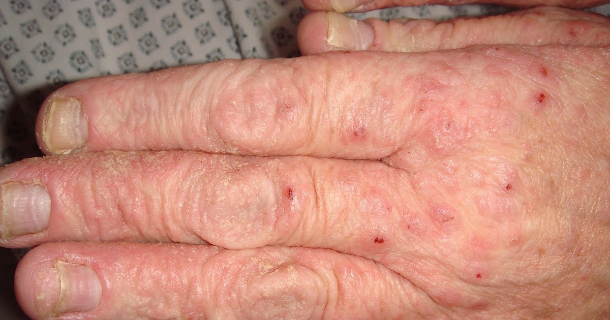Home Remedies For Treating Scabies - Natural Treatments & Cure For Scabies | Find Home Remedy 