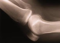 picture site - Early Signs of Osteoarthritis