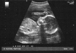 [sonogram-human-foetal-fetal-ultrasound-scan-at-22-weeks-mono-1-ANON.jpg]