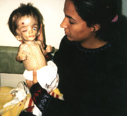 [Iraqi+child+victim+of+depleted+Uranium.jpg]