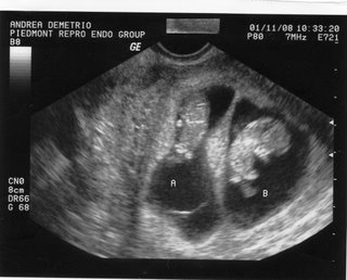 [01.11+-+Babies+ultrasound+1.jpg]