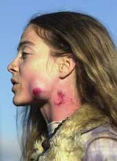 Woman with large swelling on jaw, blood