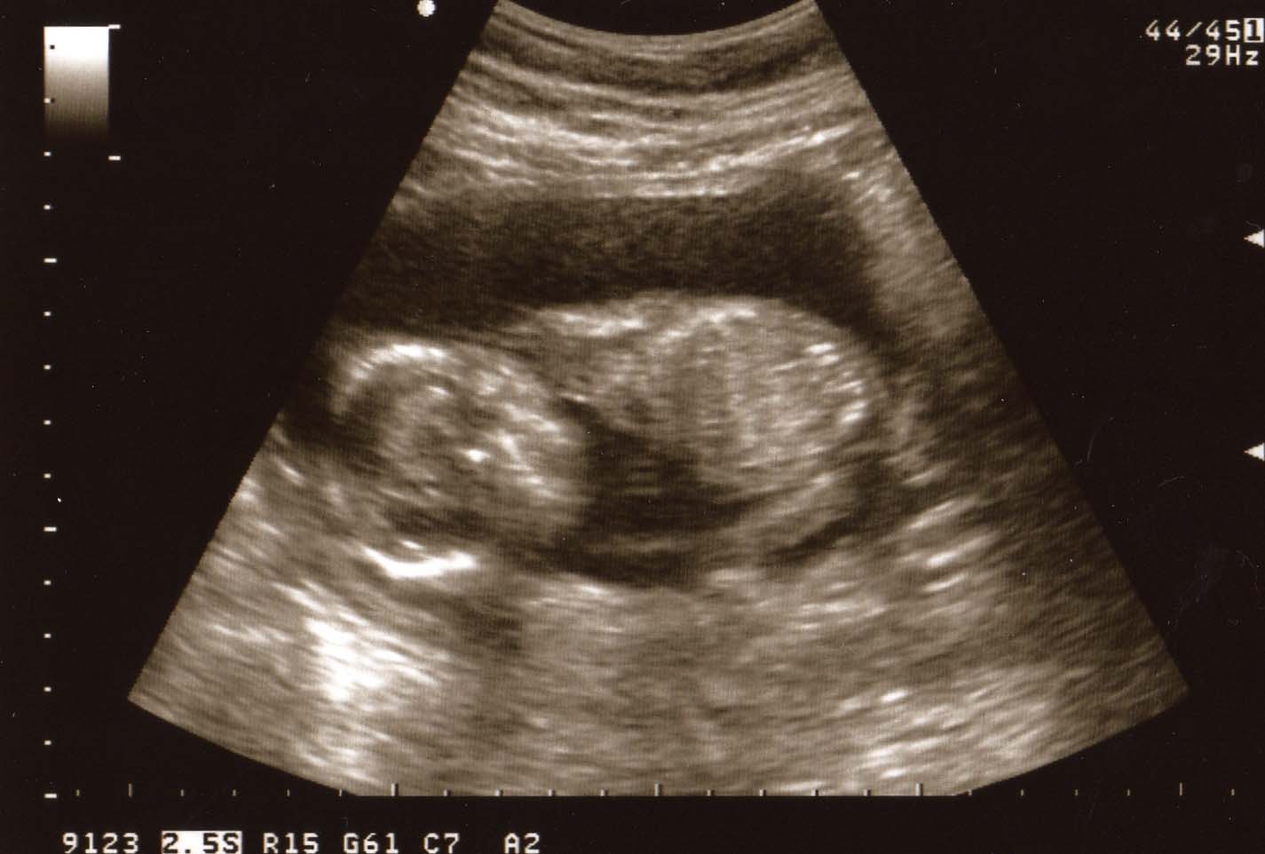 [ultrasound1.jpg]