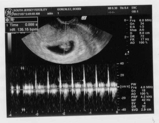[9-21-07+Ultrasound+-+More+Heartbeat+2.jpg]