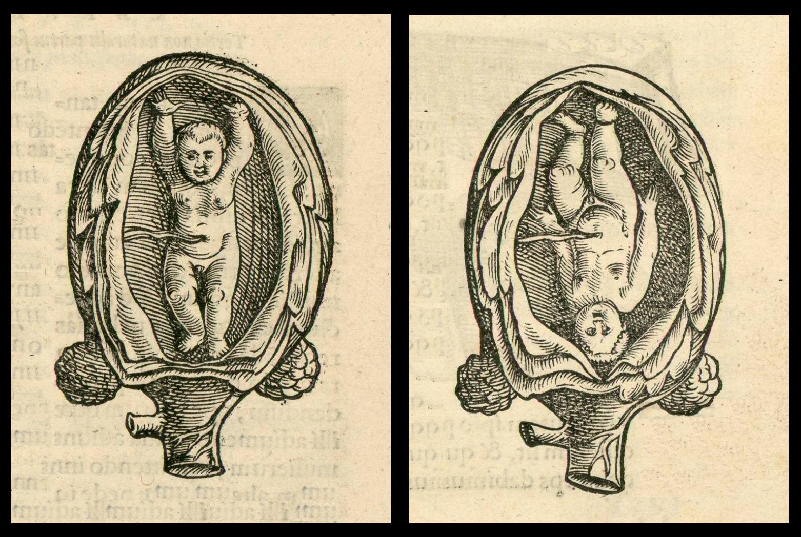 foetus upright and upside down in uterus - anatomical woodcut