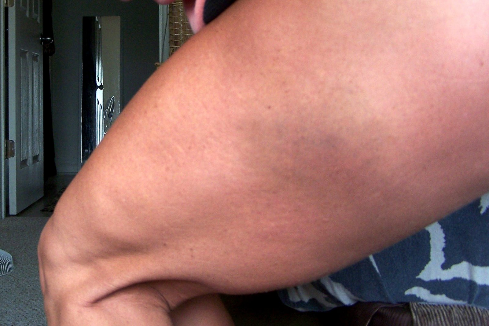 [Bruised+leg.JPG]
