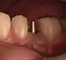 [tooth_implant.jpg]