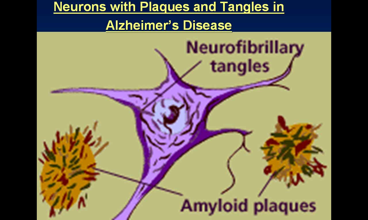 [8.+Neuron+with+Plaques.jpg]